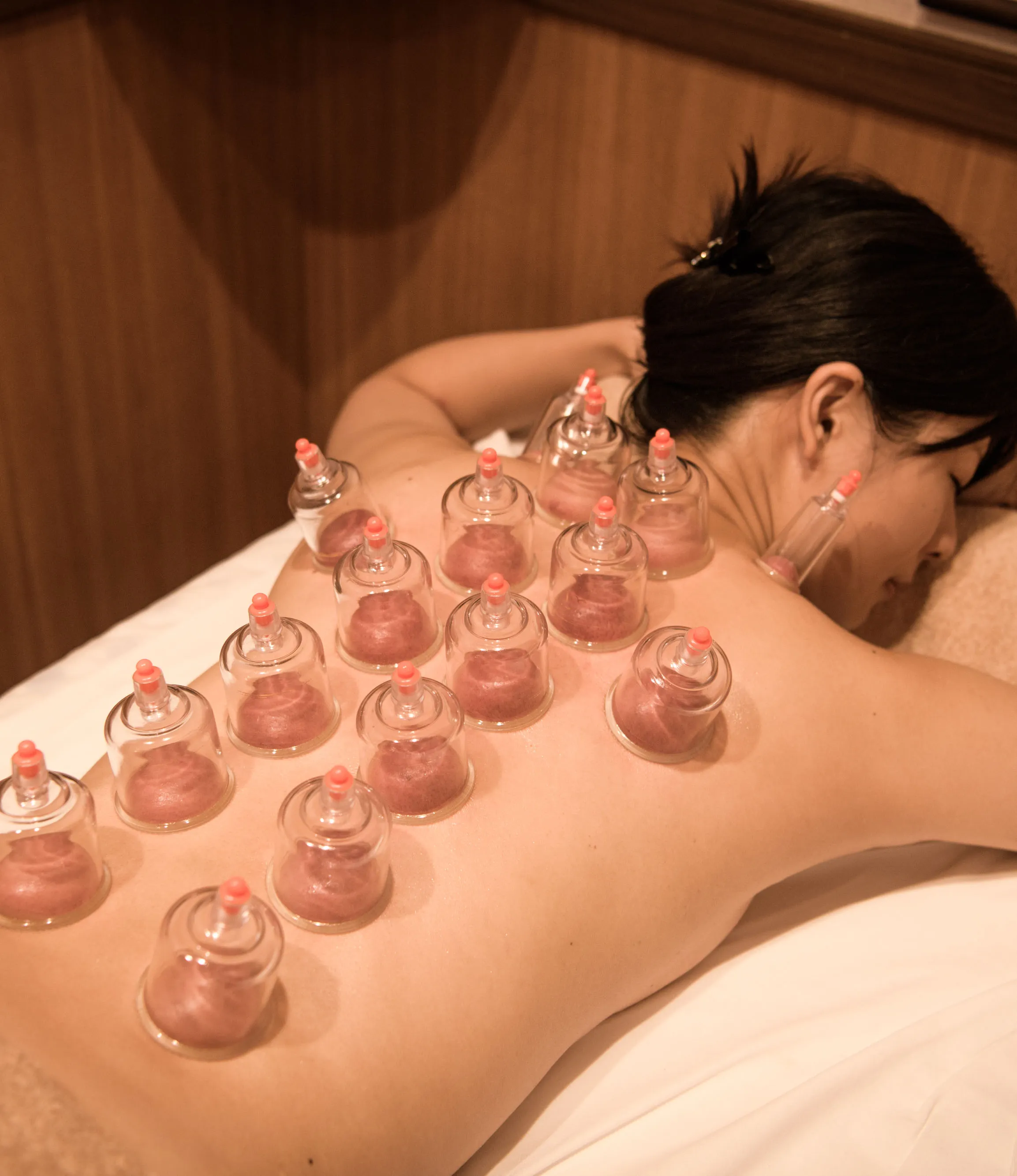 中国式カッピング